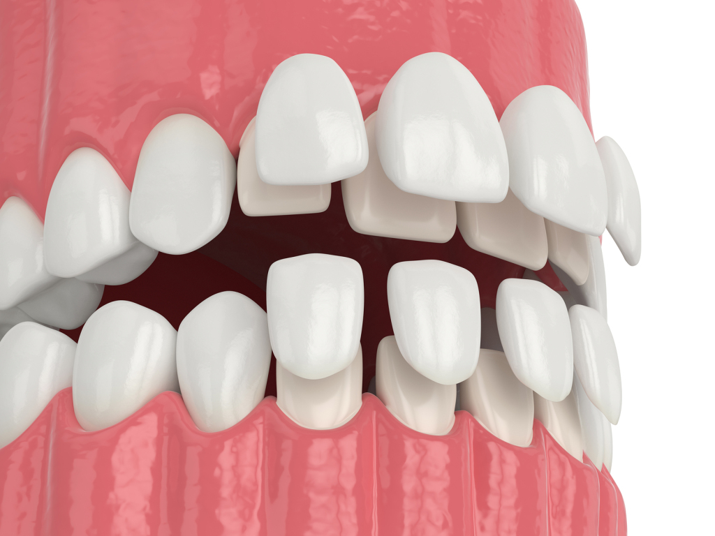Say Goodbye to the Stains Having Porcelain Veneers!