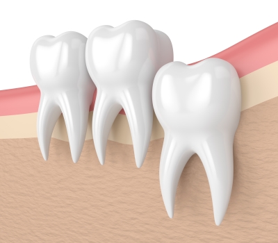 Wisdom Teeth Melbourne