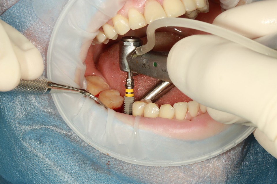 Schedule Your Appointment for Dental Implant Surgery