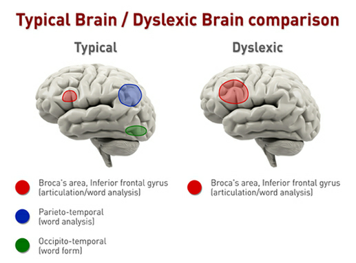 Difference in brain