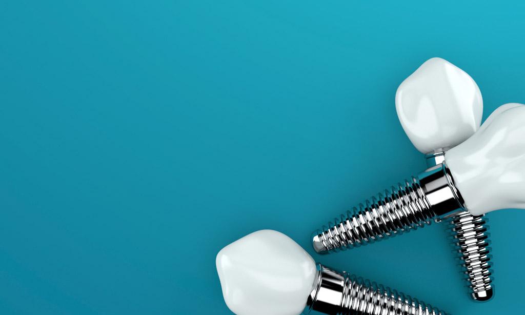 Get a Dazzling Smile With Advanced Dental Implants