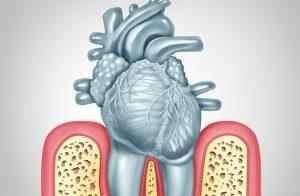 Gum Disease