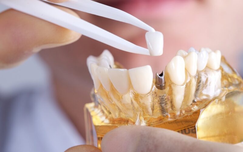 dental implants fairfield